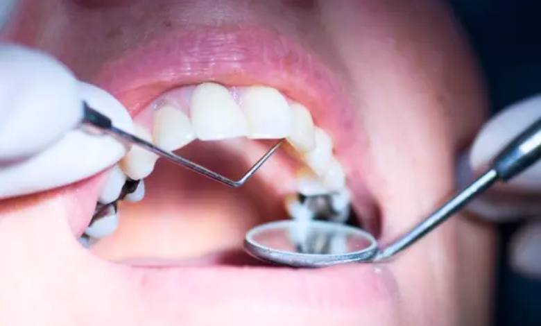 Des chercheurs développent un gel révolutionnaire pour réparer et régénérer les dents endommagées